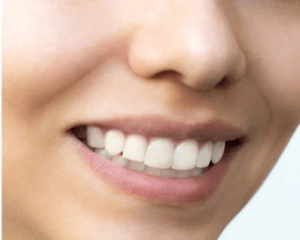 Teeth Alignment After