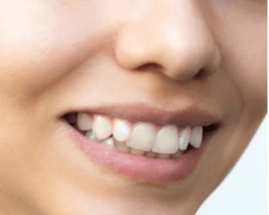 Teeth Alignment Before