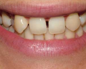 Laser Surgery Before