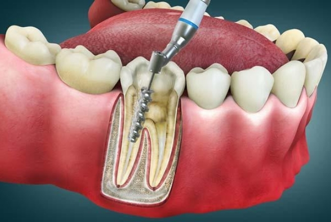 Precision Root Canal - Mankar Dental Clinic