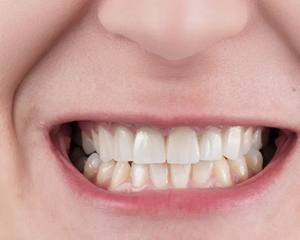 Porcelain Veneers After